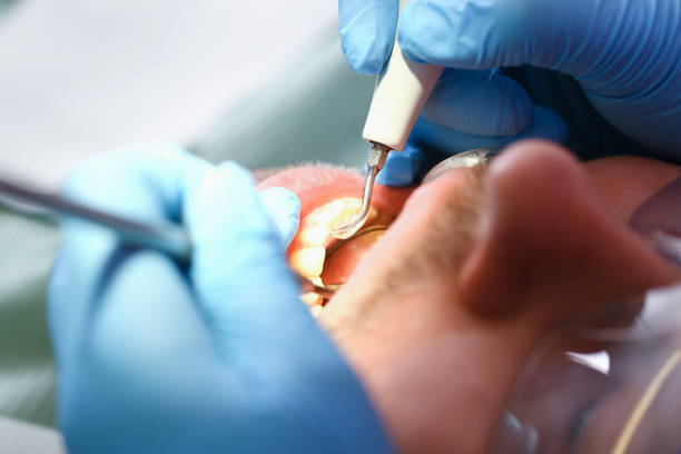 Best Emergency Dentist for Lost Fillings or Crowns in Dortches, NC